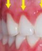 Лечение зубов у беременных: на каком сроке можно лечить кариес и пломбировать зуб с анестезией (показания по триместрам)