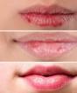 Шелушатся губы – как подобрать способы лечения?