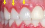 Лечение зубов у беременных: на каком сроке можно лечить кариес и пломбировать зуб с анестезией (показания по триместрам)